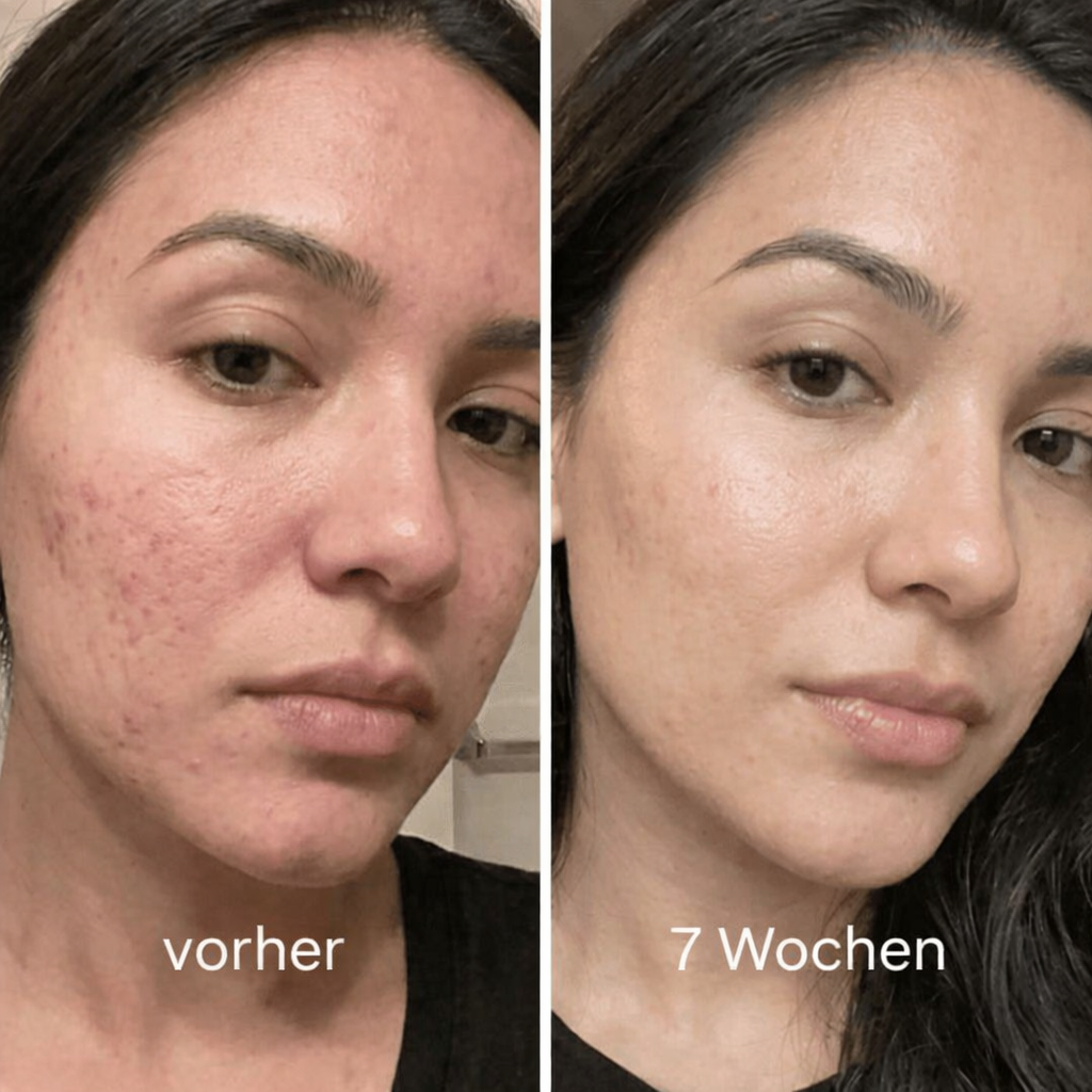 Clinical Acne Scar Remodeling Stick™