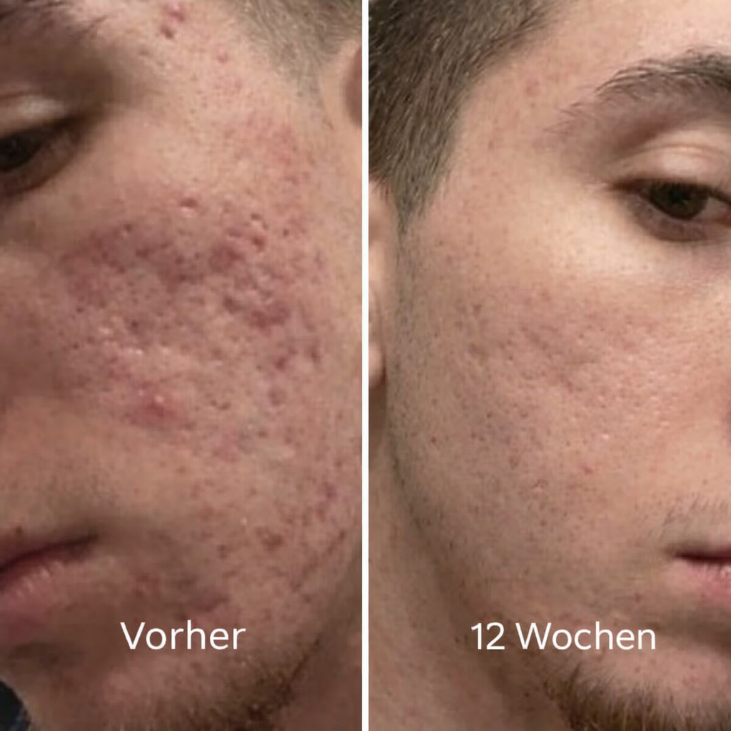 Clinical Acne Scar Remodeling Stick™